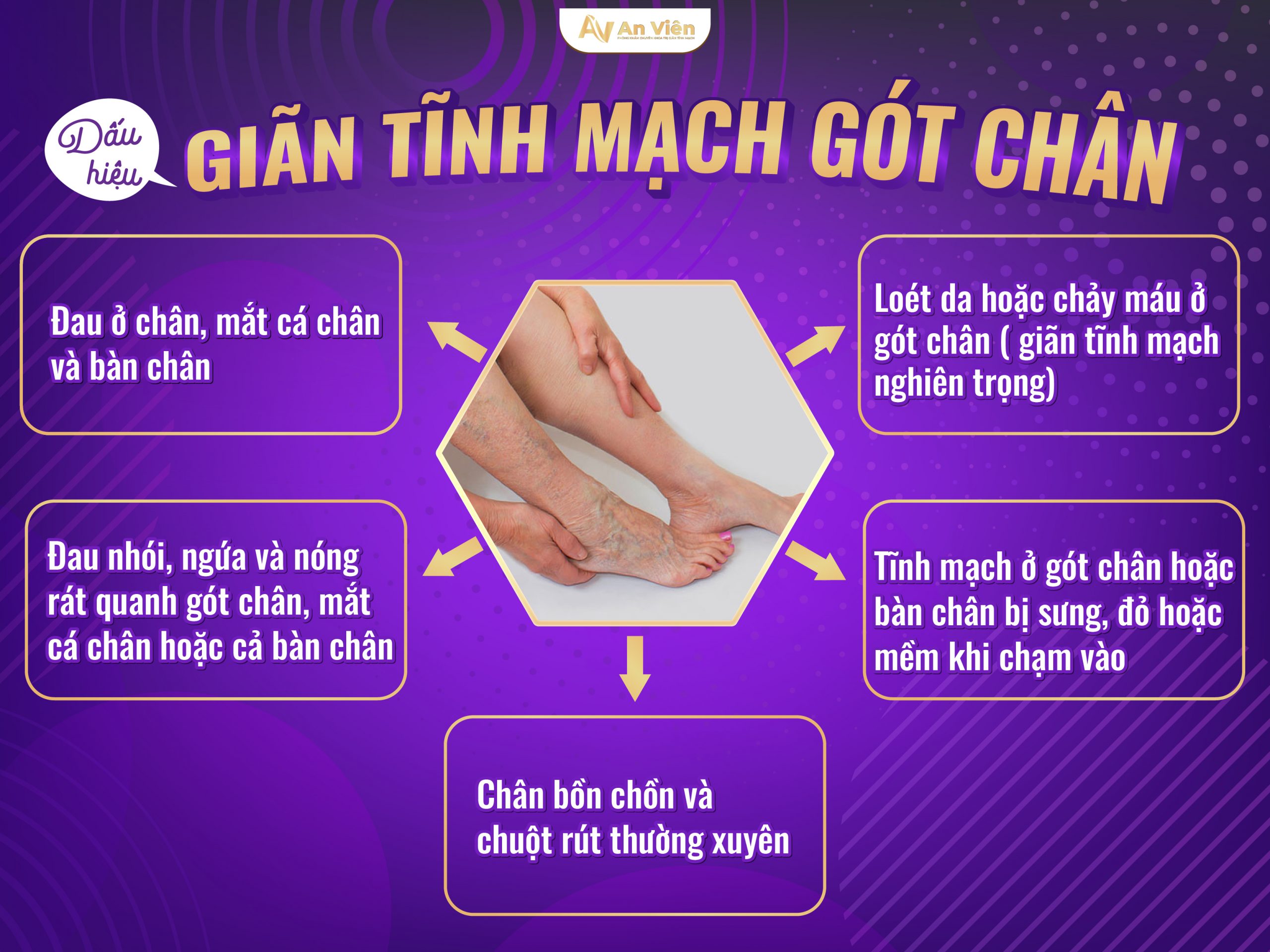 Giãn tĩnh mạch gót chân