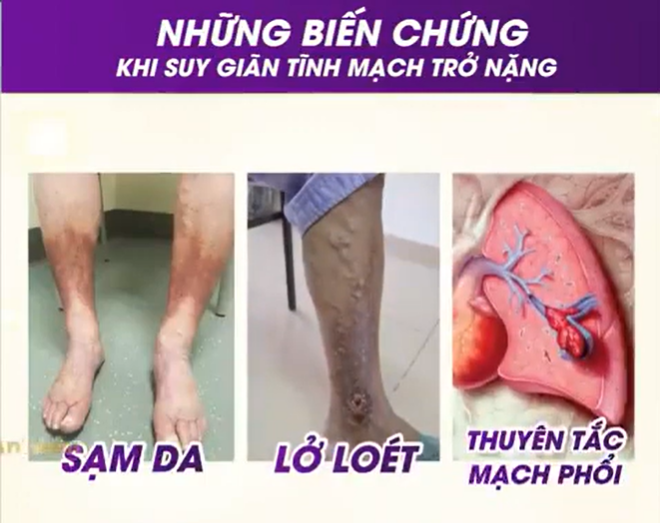 Nếu không được điều trị kịp thời sẽ dẫn đến biến chứng nguy hiểm