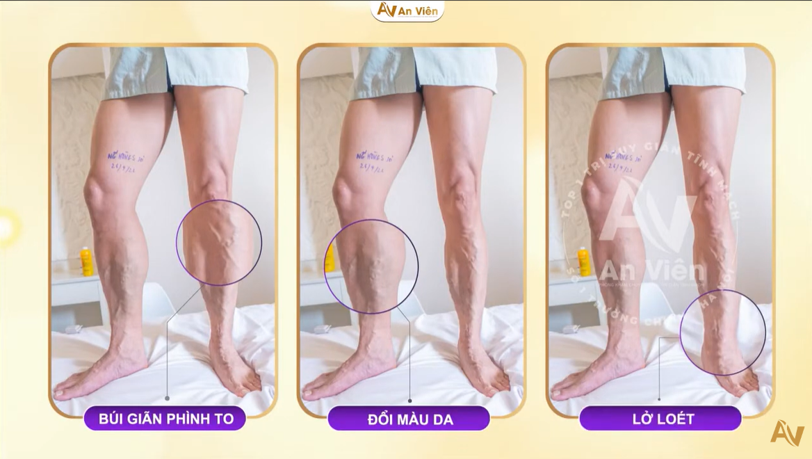 giãn tĩnh mạch biến chứng nặng