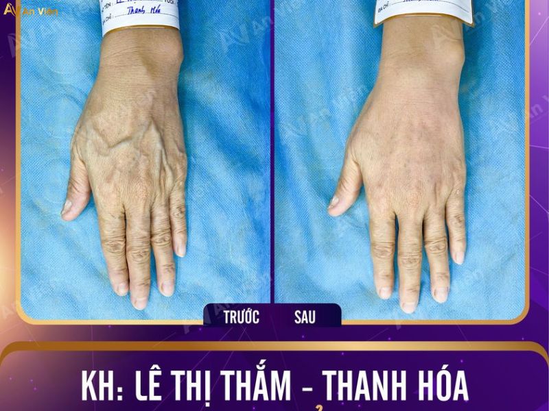 Chữa suy giãn tĩnh mạch ở đâu tốt nhất