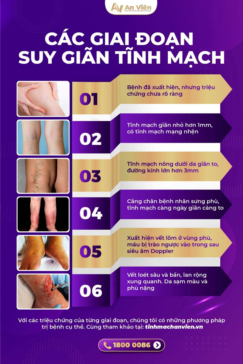 Chữa suy giãn tĩnh mạch ở đâu tốt nhất hai