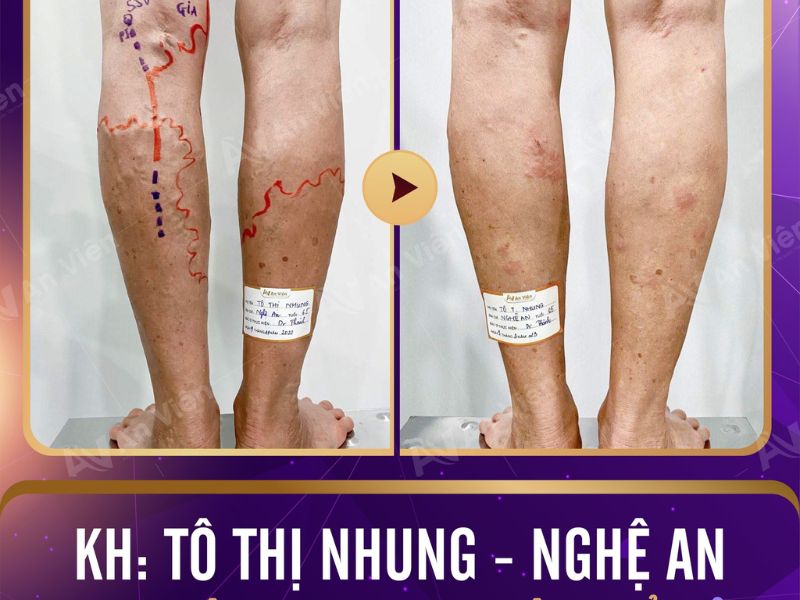 Điều trị bệnh tĩnh mạch tại Đà Nẵng