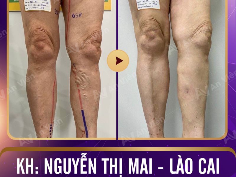 Điều trị suy giãn tĩnh mạch An Viên