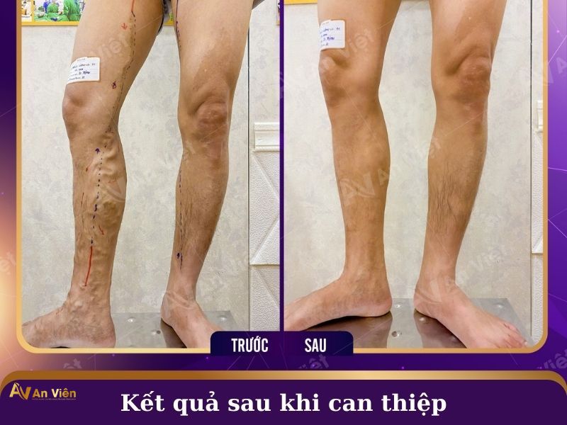 Điều trị suy giãn tĩnh mạch An Viên