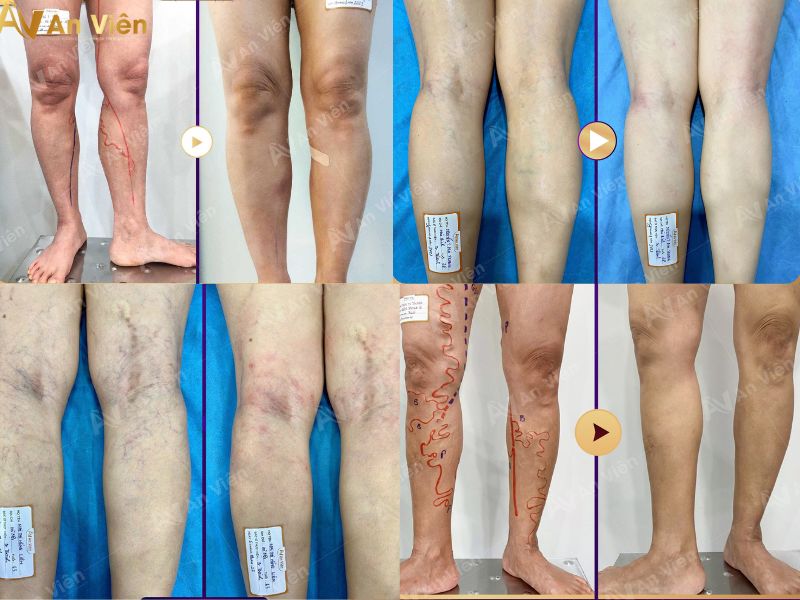 Điều trị tĩnh mạch An Viên