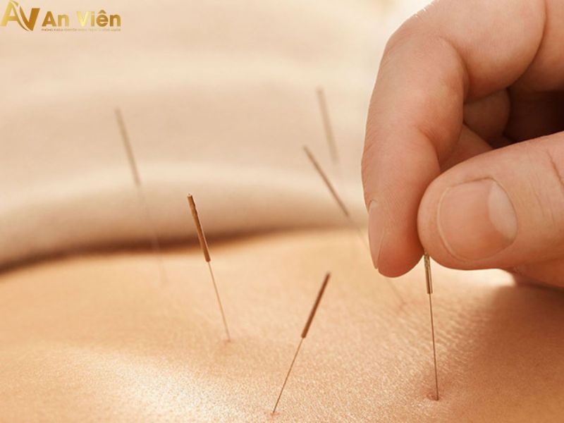 Châm cứu chữa suy giãn tĩnh mạch theo y học cổ truyền