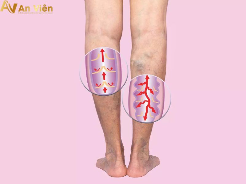 Triệu chứng suy giãn tĩnh mạch chân