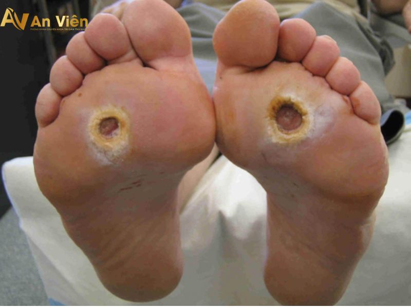 Biến chứng nặng của suy giãn tĩnh mạch bàn chân