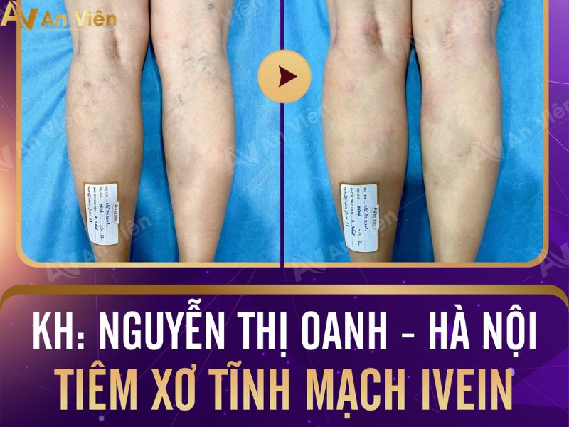 Phòng khám tiêm xơ tĩnh mạch tại An Viên