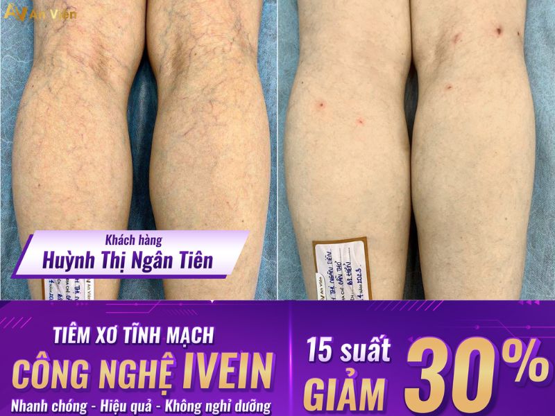giãn tĩnh mạch khám ở đâu Đà Nẵng