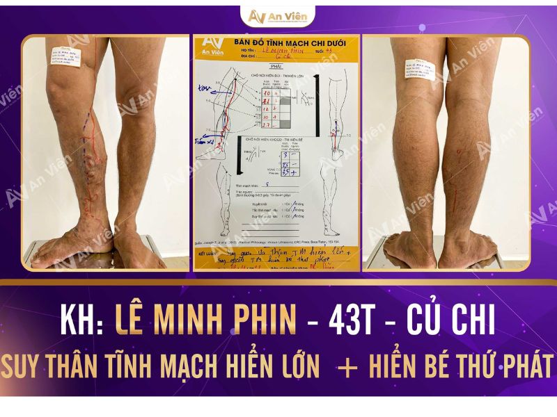 Giãn tĩnh mạch khám ở đâu Sài Gòn