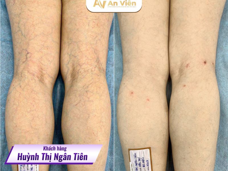 Khám giãn tĩnh mạch ở đâu Đà Nẵng