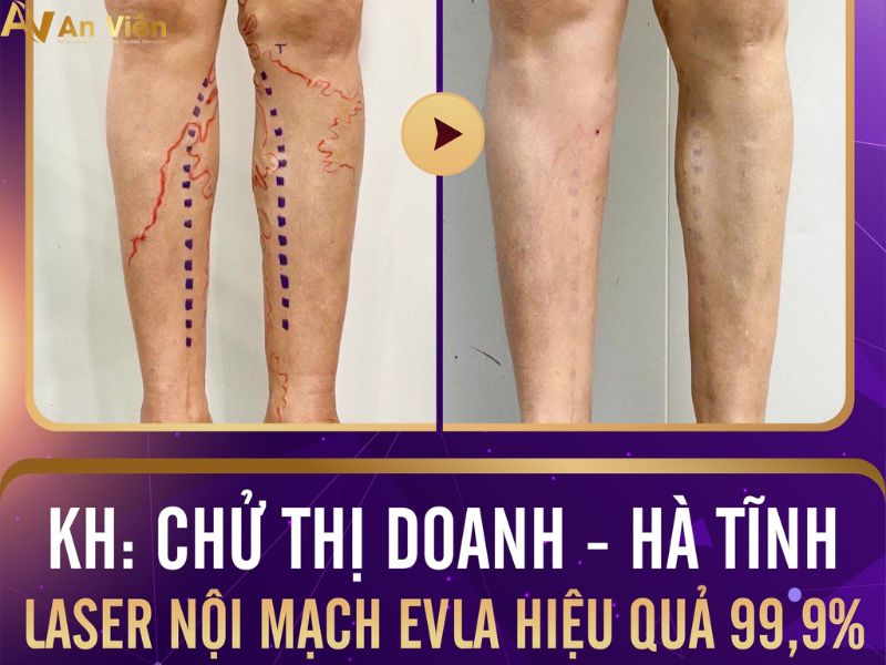 laser tĩnh mạch khám ở đâu Đà Nẵng
