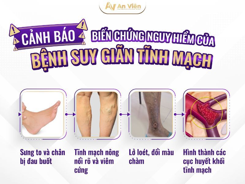 bệnh giãn tĩnh mạch khám ở đâu