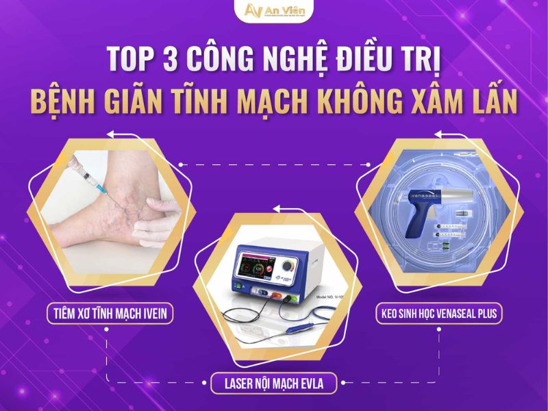 bị giãn tĩnh mạch khám ở đâu
