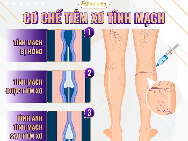 cách chữa bệnh giãn tĩnh mạch chân