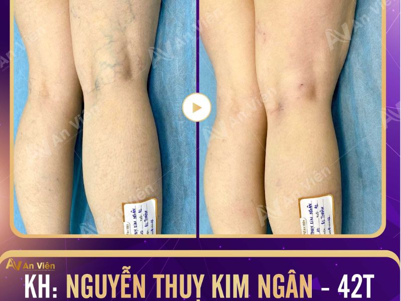 cách chữa bệnh giãn tĩnh mạch chân