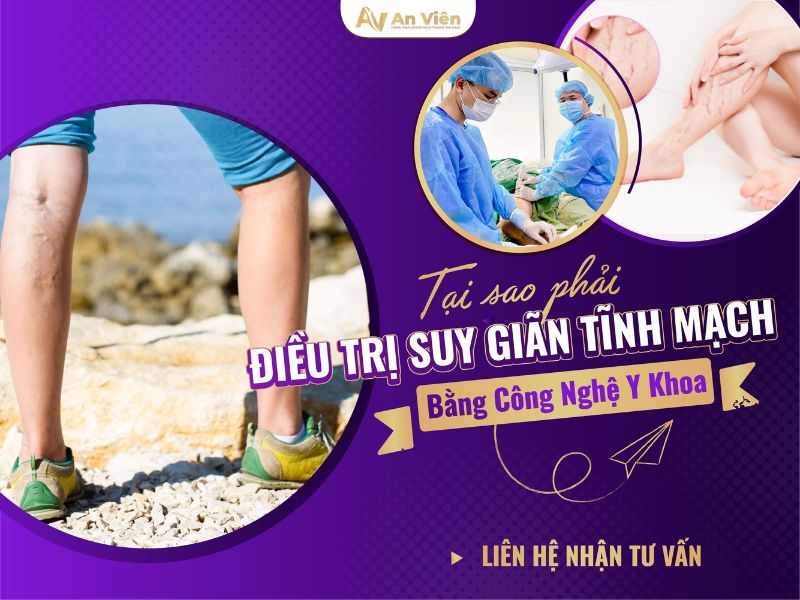 cách chữa trị giãn tĩnh mạch chân