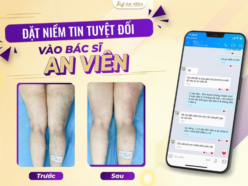 cách giảm giãn tĩnh mạch chân