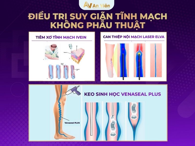 cách trị bệnh suy giãn tĩnh mạch
