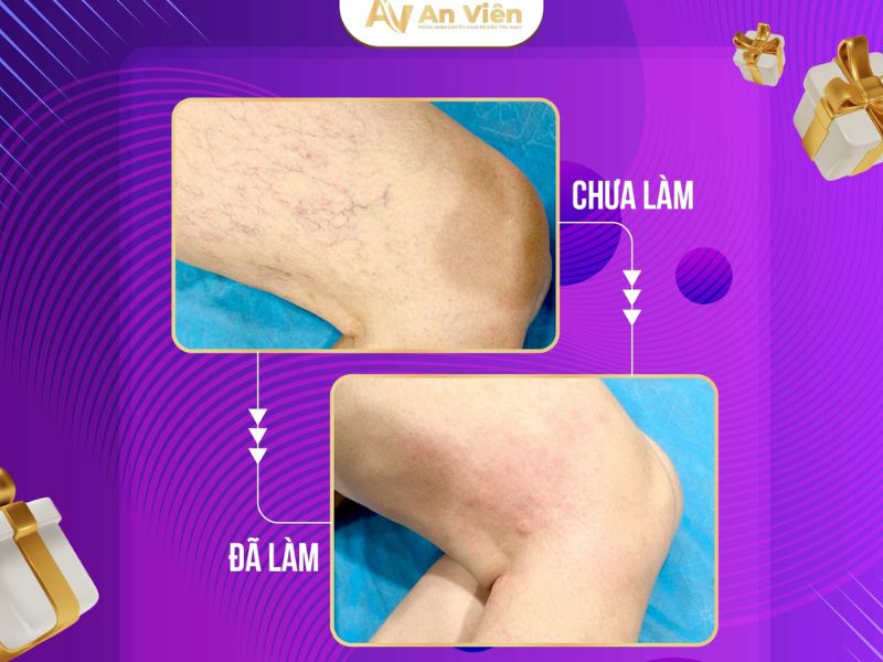 cách trị bệnh suy giãn tĩnh mạch