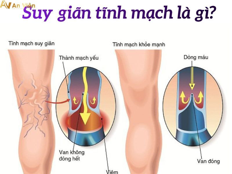 dấu hiệu của giãn tĩnh mạch