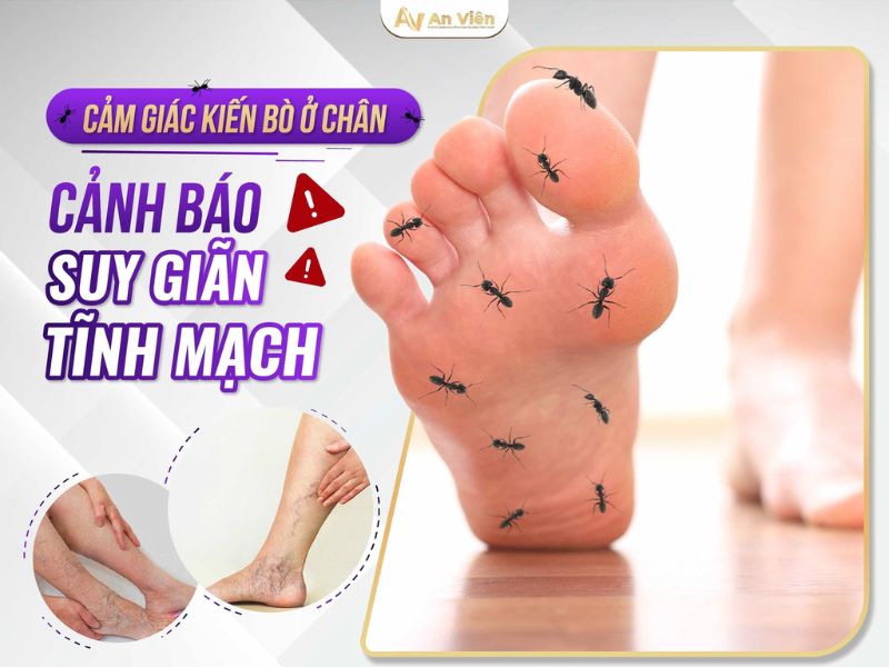 dấu hiệu của giãn tĩnh mạch