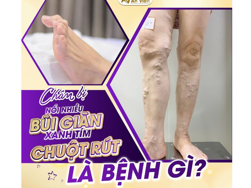 dấu hiệu của giãn tĩnh mạch