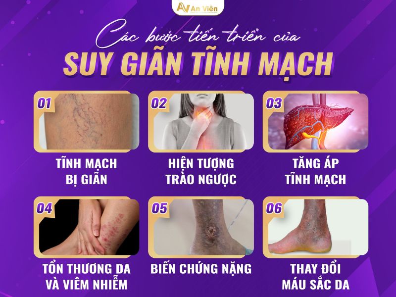 dấu hiệu của giãn tĩnh mạch