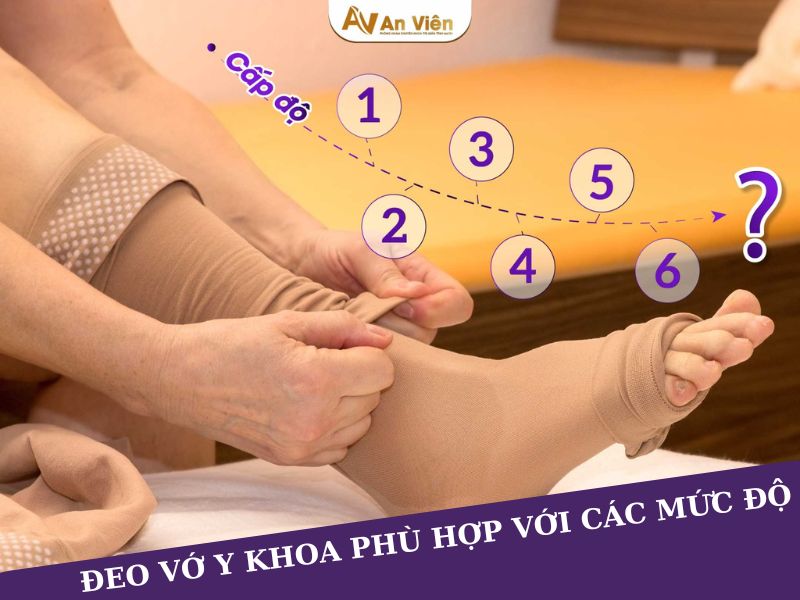dấu hiệu của giãn tĩnh mạch