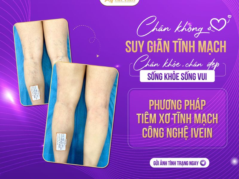 điều trị bệnh giãn tĩnh mạch