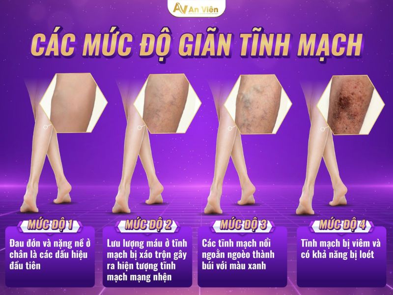 giãn tĩnh mạch và cách điều trị