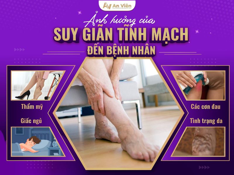 khám bệnh suy giãn tĩnh mạch ở đâu