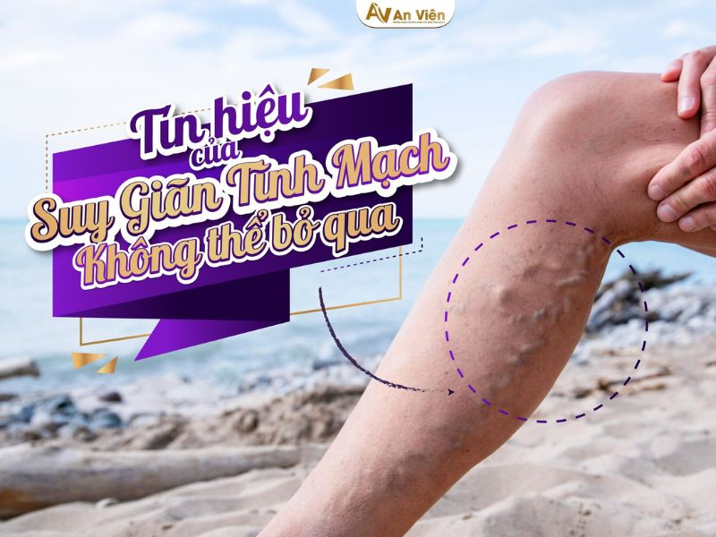 khám suy giãn tĩnh mạch ở đâu