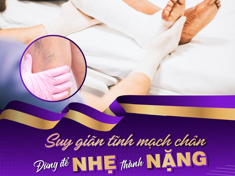 khám suy giãn tĩnh mạch ở đâu