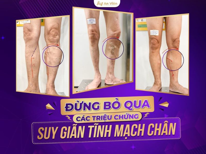 nổi gân xanh ở chân là bệnh gì