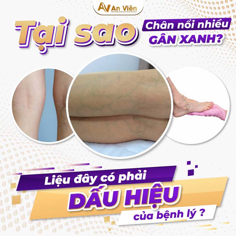 nổi gân xanh ở chân là bệnh gì