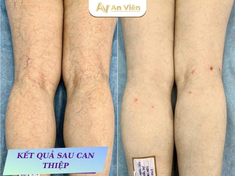 nổi gân xanh ở chân là bệnh gì