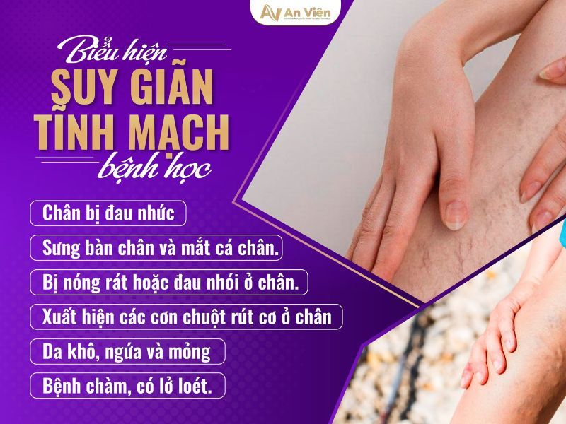 phòng ngừa suy giãn tĩnh mạch ở chânv