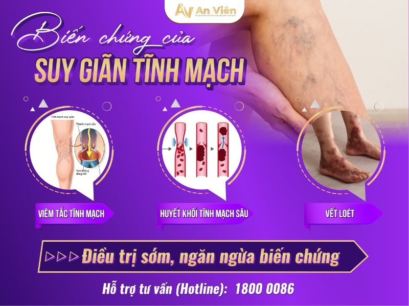 phòng ngừa suy giãn tĩnh mạch ở chân