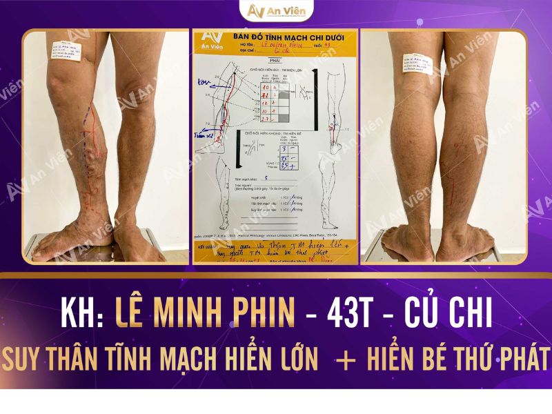 an viên chuyên khoa trị giãn tĩnh mạch