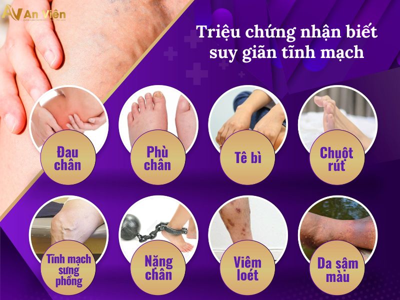 bệnh suy van tĩnh mạch chi dưới