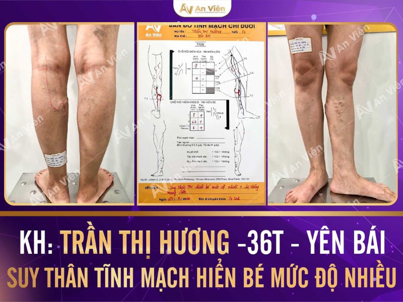 bệnh tĩnh mạch
