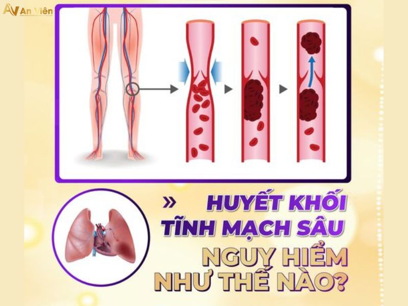 biểu hiện của bệnh giãn tĩnh mạch
