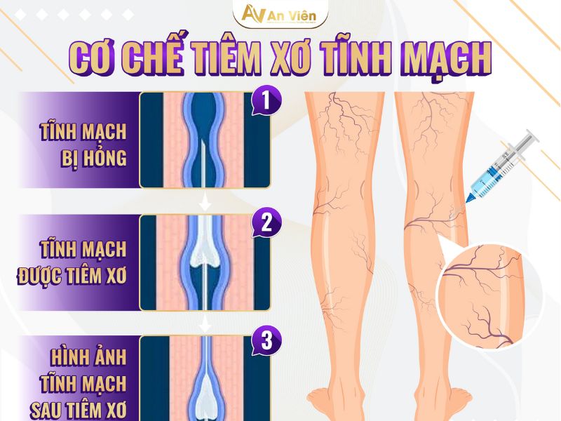 cách chữa giãn tĩnh mạch