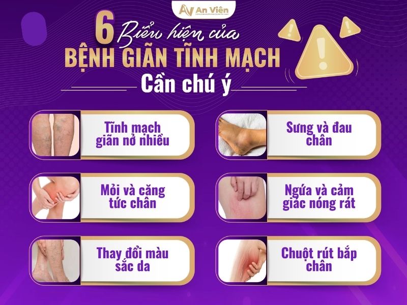 cách chữa suy giãn tĩnh mạch