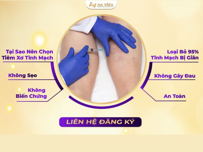 cách chữa suy giãn tĩnh mạch