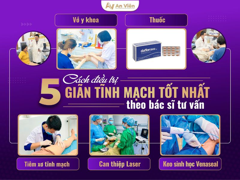 cách điều trị giãn tĩnh mạch