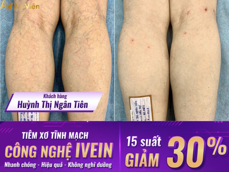 cách điều trị giãn tĩnh mạch