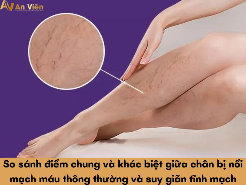 chân bị nổi mạch máu